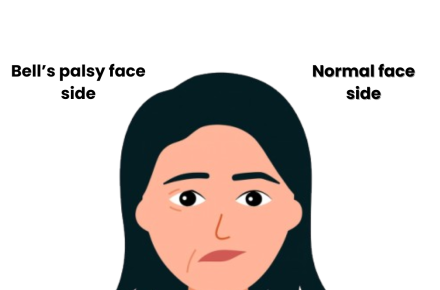 Difference Between Stroke vs Bell's Palsy