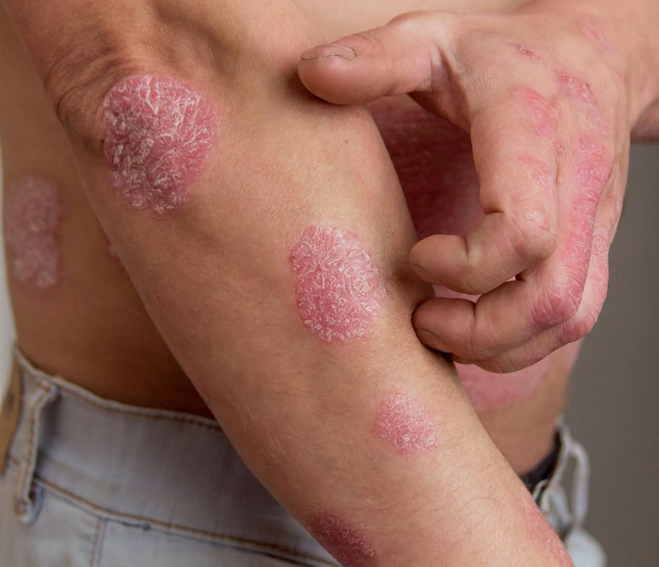 Psoriasis