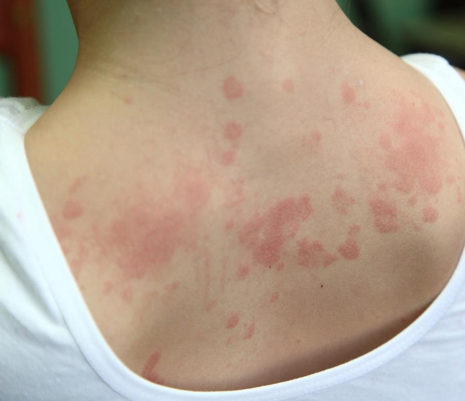 Allergic Dermatitis