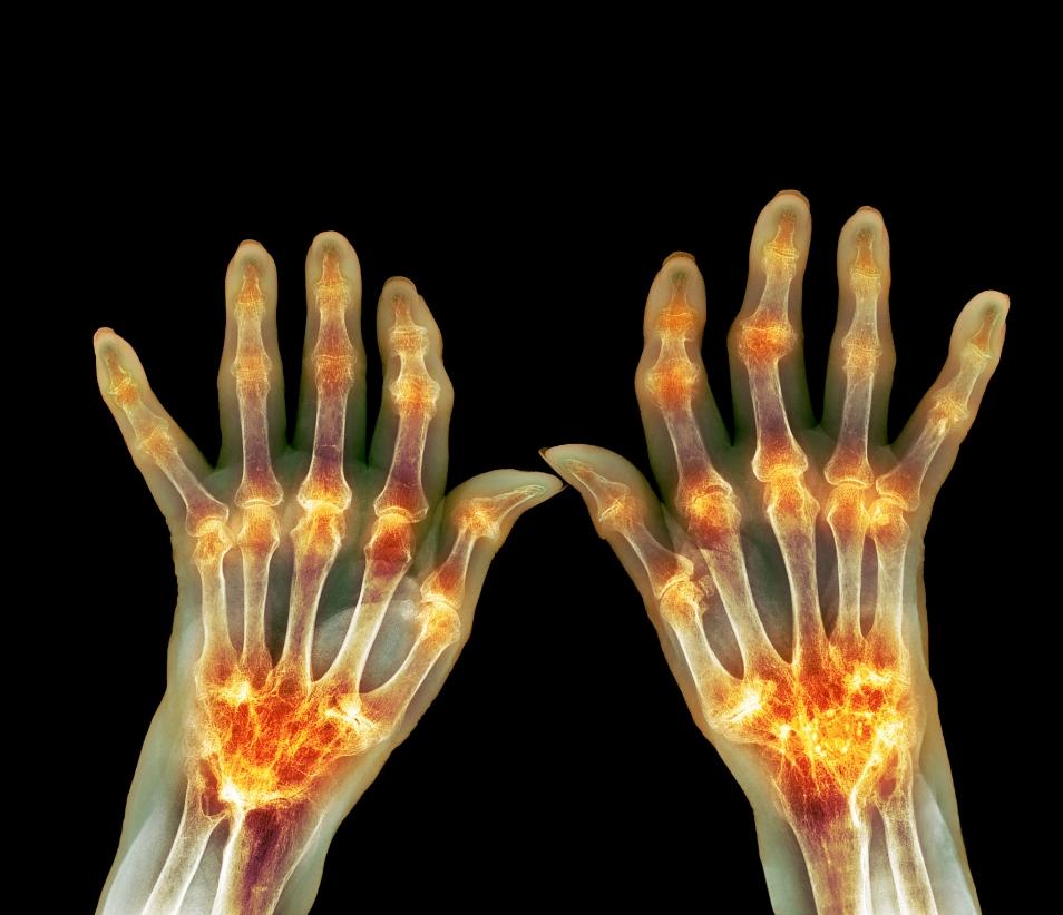 Rheumatoid Arthritis