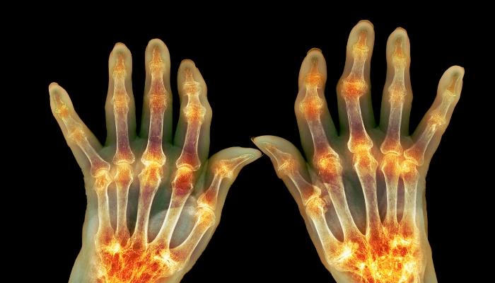 <b>Understanding Rheumatoid Arthritis</b>