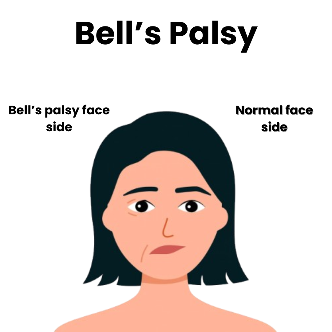 Difference Between Stroke vs Bell's Palsy